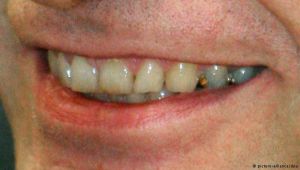 ستة أسباب غير مألوفة لاصفرار الأسنان