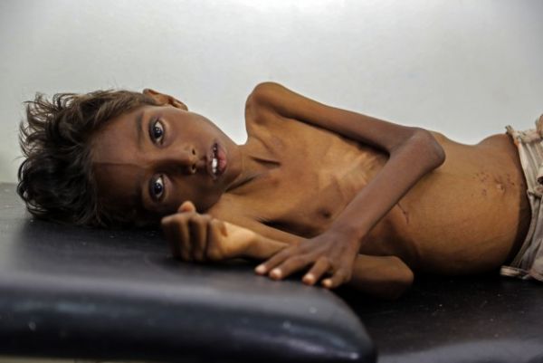 اليونيسف: معاناة الأطفال في اليمن كارثية وغير مرئية لبقية العالم