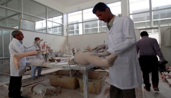 ضحايا الحرب اليمنية.. محرومون من الأطراف الصناعية