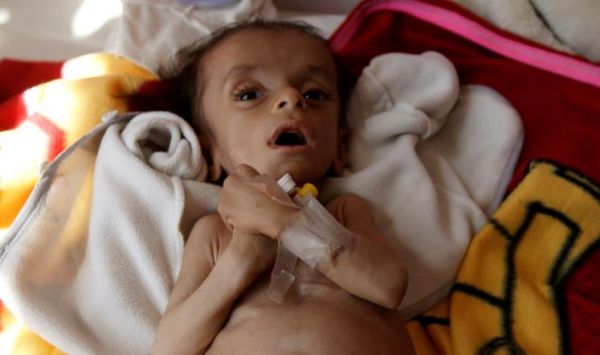الأمم المتحدة تعلن تخصيص 18 مليون دولار لمنع المجاعة في اليمن