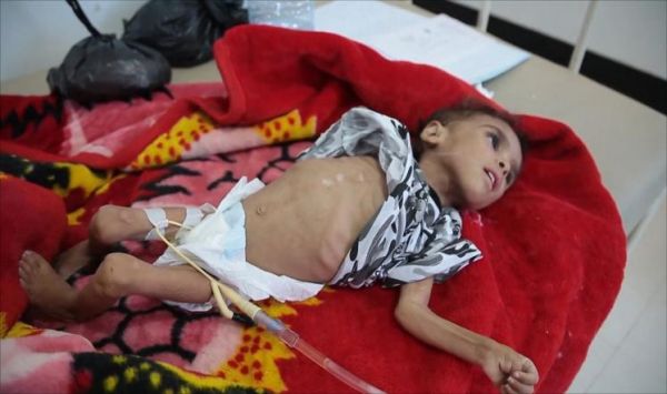 تايمز: الحصار يفتك بأطفال اليمن