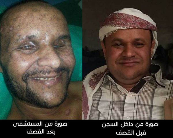 مختطف لدى الحوثيين فقد عينيه بغارة للتحالف يناشد إطلاق سراحه