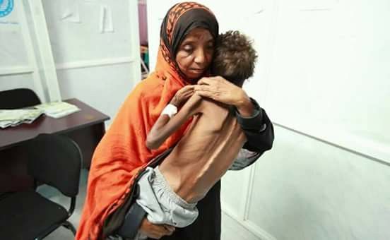 الأمم المتحدة: استمرار الحرب في اليمن يؤدي إلى أسوأ مجاعة في العالم منذ قرن