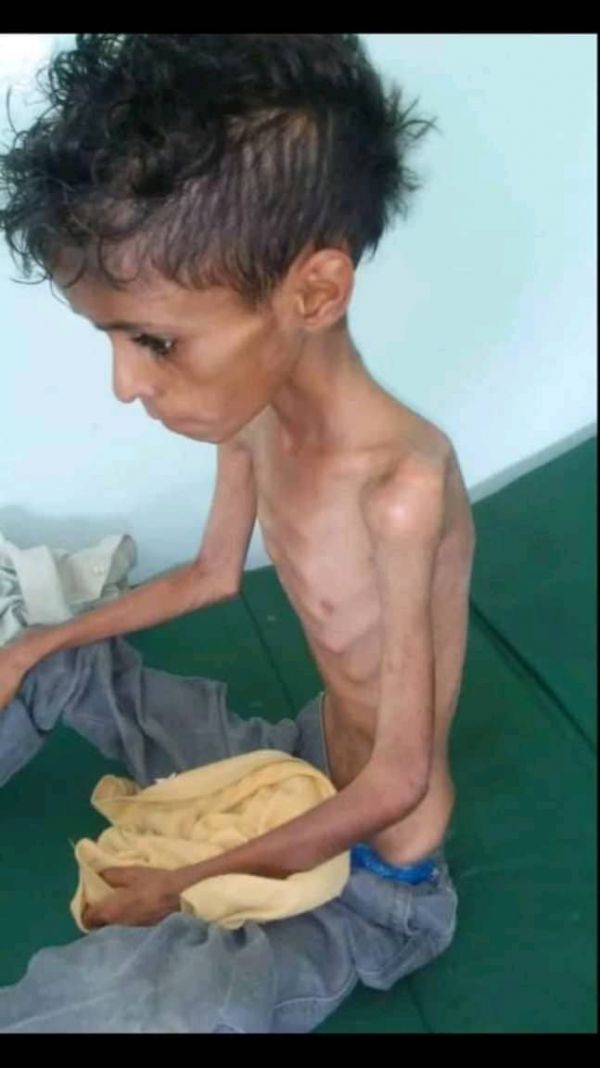 المجاعة تهدد أطفال اليمن .. الطفل 
