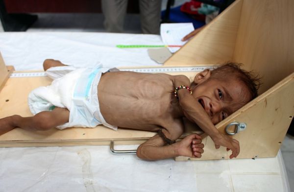 هولندا : الوضع في اليمن رهيب ومأساوي