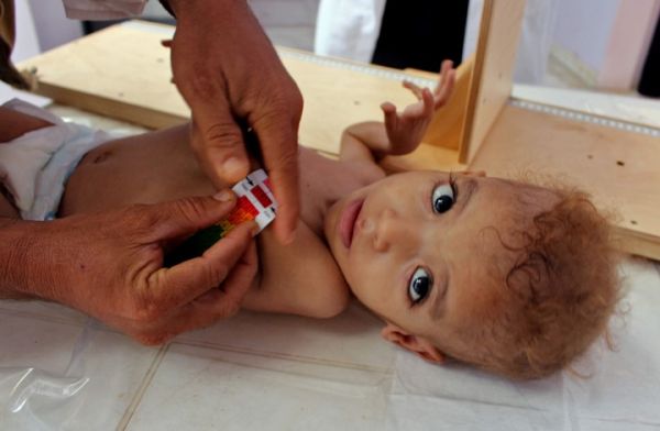 منظمة بريطانية: وفاة 85 ألف طفل يمني بسبب سوء التغذية