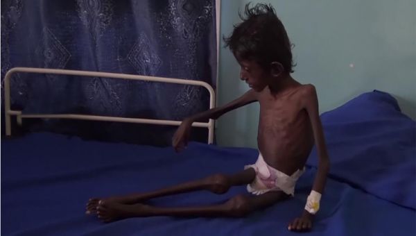 هذا ما جنته عليه حرب اليمن.. عبد الرحمن عمره 5 سنوات ويزن 5 كلغ