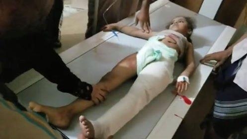 تعز.. مقتل طفلين في قصف حوثي وتسجيل إصابات جديدة بالكوليرا