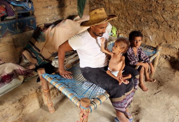 حرب اليمن تقطع طريق الأب إلى العمل.. وطفله الصغير يتضور جوعا