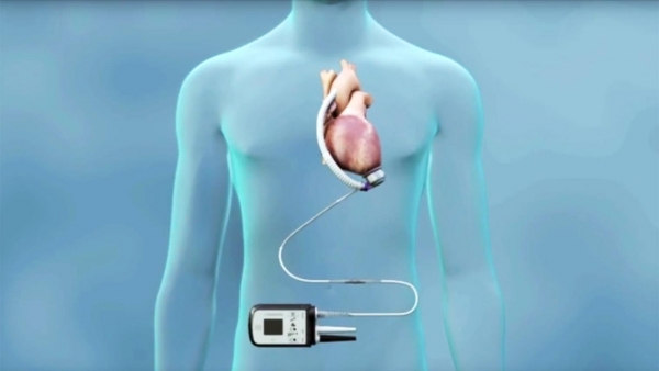 جهاز يسمح للمرضى بأن يظلوا على قيد الحياة حتى لو توقفت قلوبهم