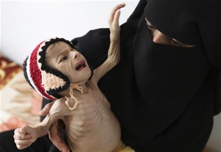 الصحة العالمية: ربع مليون يمني على حافة الموت جوعا