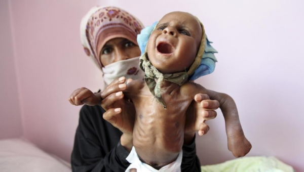 إندبندنت: حتى لو توقفت الحرب اليوم... أطفال اليمن يعانون آثار الجوع 20 عاما