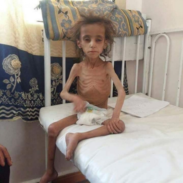 الأمم المتحدة تدعو لاتخاذ إجراءات عاجلة لمنع المجاعة في اليمن