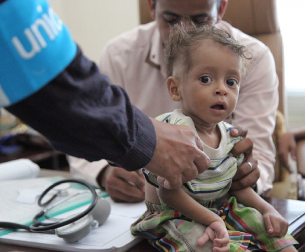 الصحة العالمية: ثلاثة من كل أربعة أطفال يعانون من سوء التغذية في اليمن