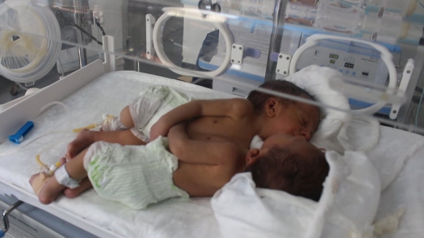 طفلان سياميان يعودان غداً الخميس إلى صنعاء بعد عملية جراحية ناجحة بالأردن