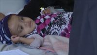 113 يمنياً يموتون يومياً بسبب نقص المساعدات