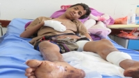 "لا تبتروا قدمي".. قصة طفلين نازحين ضحايا لغم حوثي في مأرب
