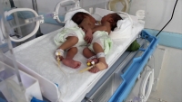 اليونيسف تتكفل بعلاج توأم سيامي في صنعاء بعد شهر من ولادتهما